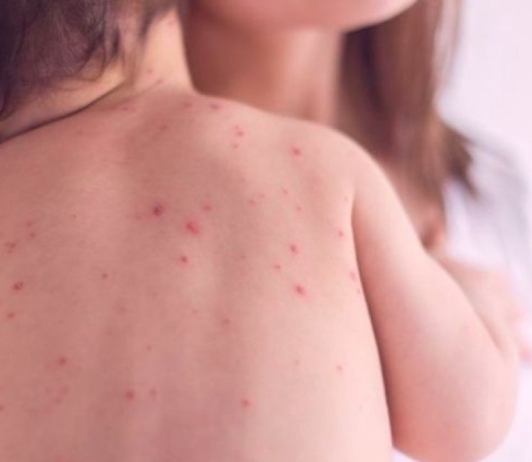Сүүлийн 24 цагт улаанбурхан өвчний тохиолдол бүртгэгдээгүй