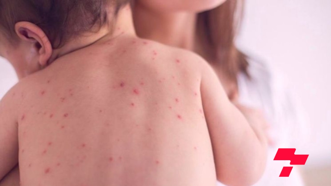 Сүүлийн 24 цагт улаанбурхан өвчний тохиолдол бүртгэгдээгүй